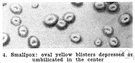 pseudovariola - a mild form of smallpox caused by a less virulent form of the virus