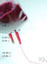 alkalosis - abnormally high alkalinity (low hydrogen-ion concentration) of the blood and other body tissues