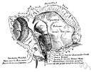 herpes simplex encephalitis - common form of acute encephalitis caused by herpes simplex 1