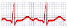 ECG - a graphical recording of the cardiac cycle produced by an electrocardiograph