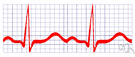electrocardiogram - a graphical recording of the cardiac cycle produced by an electrocardiograph