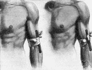 tourniquet - bandage that stops the flow of blood from an artery by applying pressure