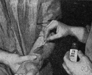 Mercurochrome - a mercurial compound applied topically as an antiseptic