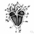 mitral stenosis - obstruction or narrowing of the mitral valve (as by scarring from rheumatic fever)