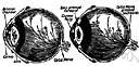 closed-angle glaucoma - glaucoma in which the iris blocks the outflow of aqueous humor