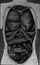 dumdum fever - leishmaniasis of the viscera