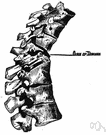spinal curvature - an abnormal curvature of the vertebral column