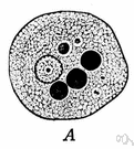 amebiosis - infection by a disease-causing ameba