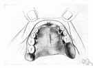 plate - a dental appliance that artificially replaces missing teeth