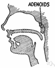 tonsilla pharyngealis - a collection of lymphatic tissue in the throat behind the uvula (on the posterior wall and roof of the nasopharynx)