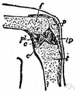 meniscectomy - surgical removal of the meniscus of the knee
