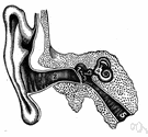 Menière's disease - a disease of the inner ear characterized by episodes of dizziness and tinnitus and progressive hearing loss (usually unilateral)
