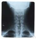 spinal cord - a major part of the central nervous system which conducts sensory and motor nerve impulses to and from the brain