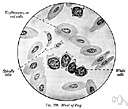 megaloblastic anemia - anemia characterized by many large immature and dysfunctional red blood cells (megaloblasts) in the bone marrow