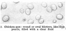 lues venerea - a common venereal disease caused by the treponema pallidum spirochete