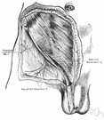 inguinal hernia - hernia in which a loop of intestine enters the inguinal canal