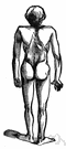 Pott's disease - TB of the spine with destruction of vertebrae resulting in curvature of the spine Pott's disease - TB of the spine with destruction of vertebrae resulting in curvature of the spine