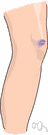 contusion - an injury that doesn't break the skin but results in some discoloration