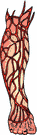 milk leg - painful thrombosis of the femoral vein in the leg following childbirth