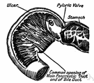 musculus sphincter pylori - the sphincter muscle of the pylorus that separates the stomach from the duodenum