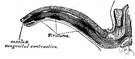 stenosis - abnormal narrowing of a bodily canal or passageway