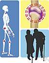 rheumatoid arthritis - a chronic autoimmune disease with inflammation of the joints and marked deformities