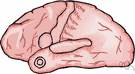 phrenitis - inflammation of the brain usually caused by a virus