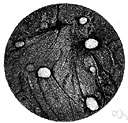 framboesia - an infectious tropical disease resembling syphilis in its early stages