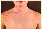 German measles - a contagious viral disease that is a milder form of measles lasting three or four days
