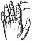 tumesce - expand abnormally