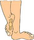 tinea pedis - fungal infection of the feet