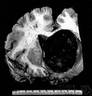 meningioma - a tumor arising in the meninges which surround the brain and spinal cord
