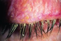 Fig. B3 Hard scales in staphylococcal blepharitis