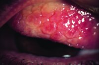 Fig. C14 Cobblestones papillae in severe vernal conjunctivitis