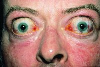 Fig. E7 Severe bilateral exophthalmos and lid retraction in Graves disease. (From Kanski 2003, with permission of Butterworth-Heinemann)