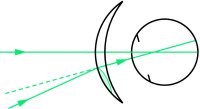 Fig. J1 Image jump upward caused by the segment of a bifocal lens, as the direction of gaze is lowered across the dividing line