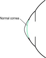 Fig. K1 Schematic diagram of a keratoconus cornea