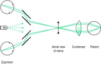 Fig. O1 Binocular indirect ophthalmoscope. The light source mounted above and between the examiners eyes illuminates the condenser, which images the source at the periphery of the patients pupil. The illumination does not overlap the observation beam. The condenser lens is handheld; it forms an inverted aerial image of the retina