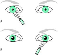 Fig. P24 Swinging flashlight test performed in a darkened room. A, stimulation of the normal eye results in bilateral pupil constriction