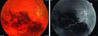Fig. R12 Major inferior branch retinal vein occlusion. Note the extensive dot-blot and flame-shaped haemorrhages affecting the sector of the retina drained by the obstructed vein. The right-hand-side photo is a flurescein angiogram showing hypofluorescence due to the blockage by blood