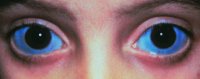 Fig. S3 Blue sclera