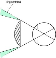 Fig. S5 Ring scotoma produced by a strong convex spectacle lens (shaded area)