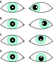 Fig. S15 A, left convergent strabismus; B, left divergent strabismus; C, left hypertropia; D, left hypotropia