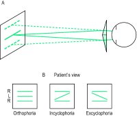 Fig. T5 A, Maddox double prism used to measure cyclophoria. If, for example, the double prism is placed in front of the right eye (ensuring that the common base exactly bisects the the pupil horizontally) the patient sees two parallel horizontal lines (discontinuous lines); B, with both eyes the patient sees three lines: if the central line L seen by the left eye appears parallel to both the upper and lower lines R produced by the double prism, the subject is free of cyclophoria, otherwise cyclophoria is present