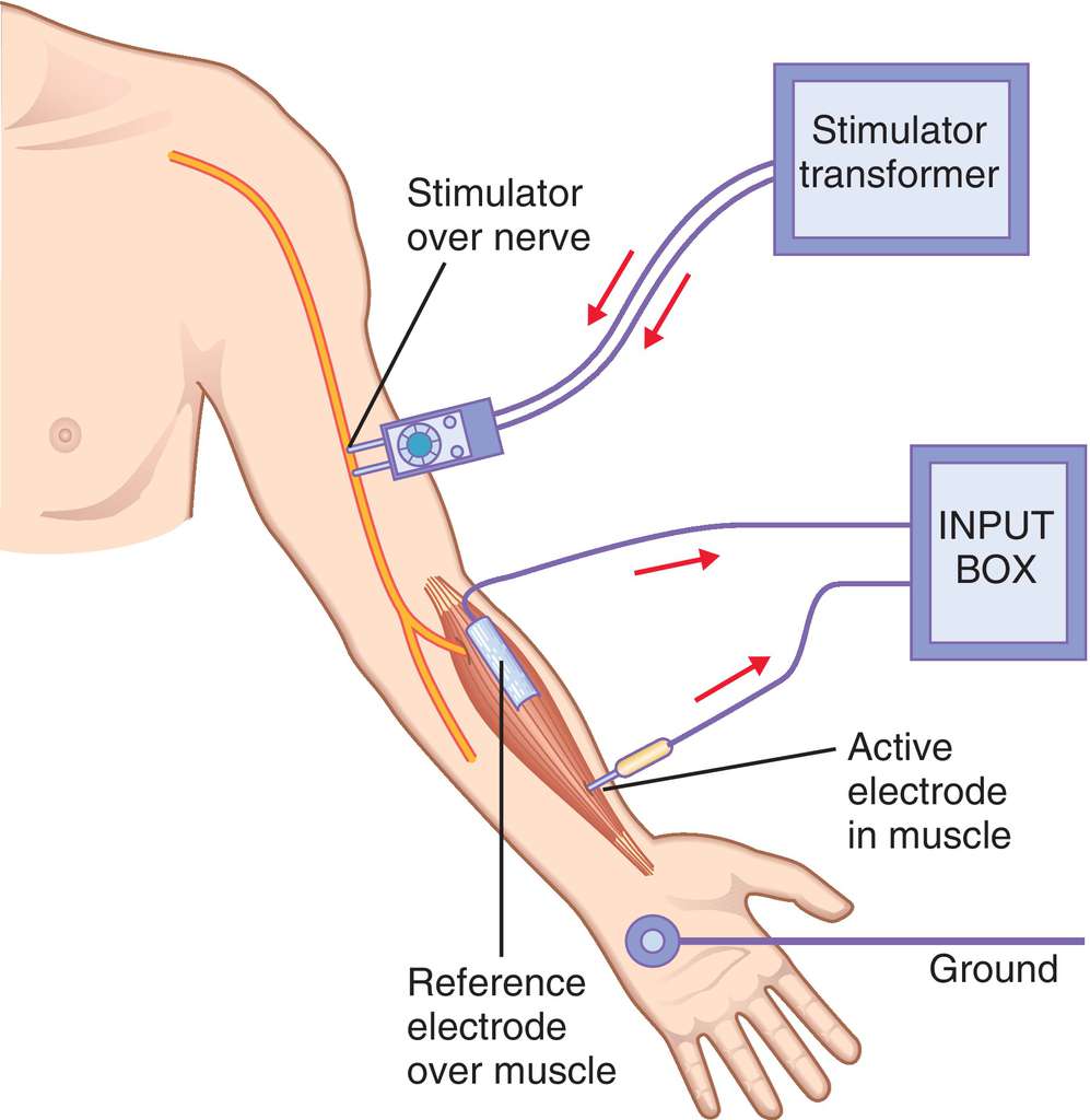 EMG (Electromyography): What It Is, Purpose, Procedure, 58% OFF