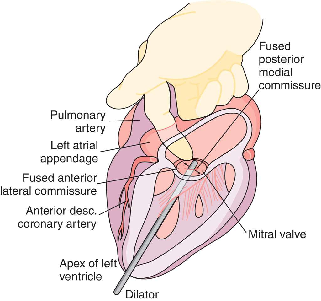 Full Size Picture mitral commissurotomy.jpg