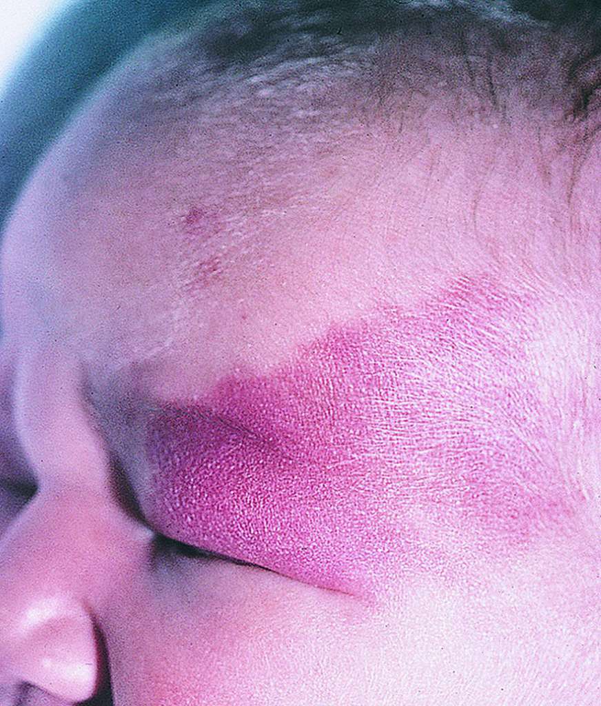 Nevus Flammeus Nevus Simplex A Reconsideration Of Nomenclature Sites Nevus Flammeus Nevus Simplex A Reconsideration Of Nomenclature Sites