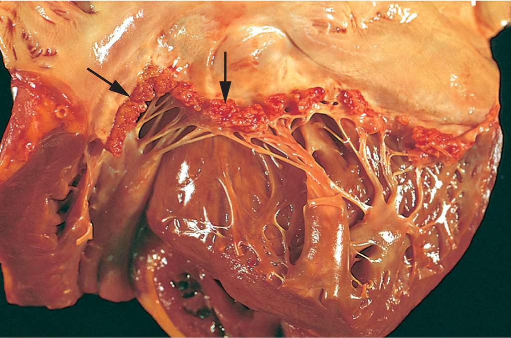 Full Size Picture Nonbacterial Thrombotic Endocarditis Jpg