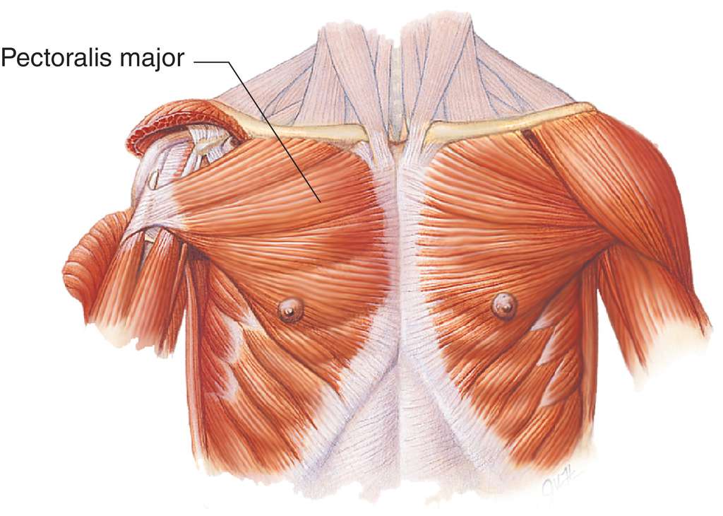 Удаление грудной мышцы. Pectoralis Major мышца. M pectoralis Major прикрепление. Pectoralis Major анатомия. Большая грудная мышца: Ключичная, грудинная..