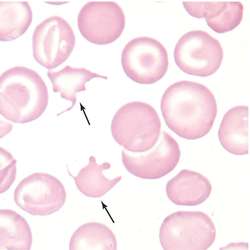 Acanthocyte | definition of acanthocyte by Medical dictionary